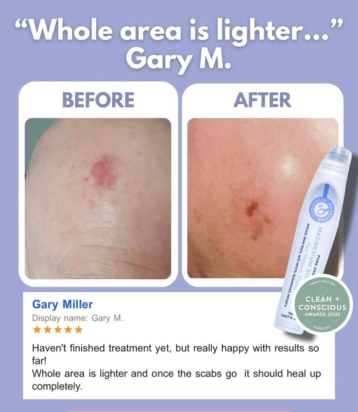 
                  
                    The Viral Magnesium Super Stick™ — For Skin Tags, Moles, Keratosis & Blemishes
                  
                